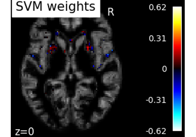 Voxel-Based Morphometry on Oasis dataset